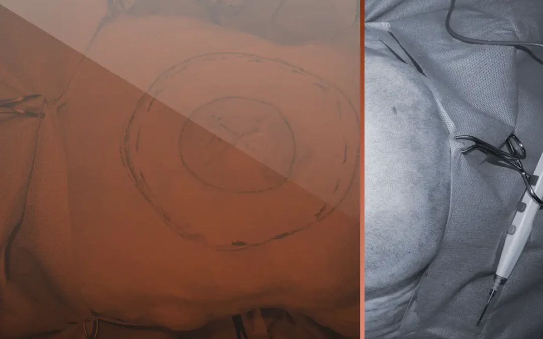 Focus On – Surgical Oncology